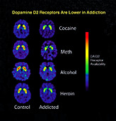Healthy and Addicted Brains,PET Scans