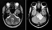 MRI of Normal Brain and Acute MS