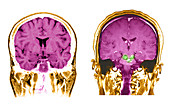 MRI of Brainstem Malformations