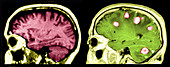 MRI of Brains,Normal and with Tumours