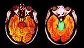 MRI of Normal Brain and Brainstem Glioma