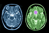 Normal Brain and Meningioma
