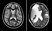 MRI of Normal Brain and Hemispherectomy