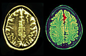 MRI of Normal and Injured Brains