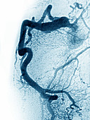 Right Coronary Artery,LM