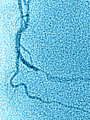 Myocardial Infarction,Angiogram