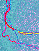 Myocardial Infarction,Angiogram