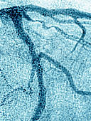 Myocardial Infarction,Angiogram