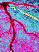 Myocardial Infarction,Angiogram