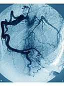 Myocardial Infarction,Angiogram