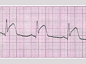 Myocardial Infarction,ECK