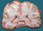 Fat Embolism in Brain
