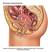 Stress Incontinence in Female Anatomy