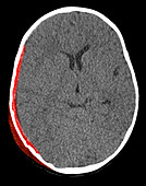 Subdural Hematoma,CT Scan