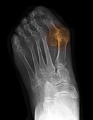 Foot X-ray Showing Bunions