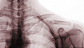 Clavicle Fracture,X-ray