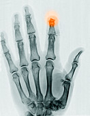 Finger Amputation,X-ray