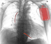 Implanted Defibrillator,X-ray