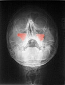 Maxillary Sinus Fracture,X-ray
