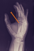 Nail in Hand,X-ray