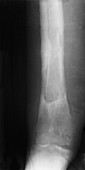 Osteomyelitis of Tibia,X-ray