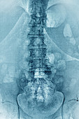 Degenerative disc disease,X-ray