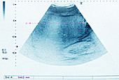 Hepatomegaly,pelvic ultrasound