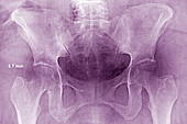 Asymmetrical Hips,X-ray