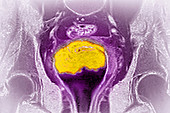 Cervical Cancer,MRI