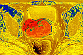 Cervical Cancer,MRI