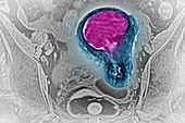 Uterine cancer,MRI
