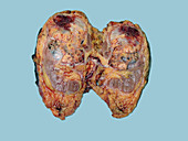 Renal Cell Carcinoma