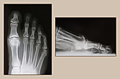 Osteoarthritis of Big Toe,X-rays