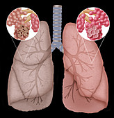Illustration of Emphysema,Illustration