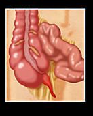 Inflamed Appendix,Illustration