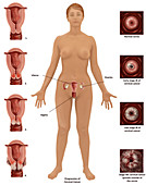 Cervical Cancer,Illustration