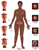 Cervical Cancer,Illustration