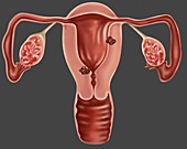 Endometrial Cancer,Illustration