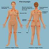 Fibromyalgia,Illustration