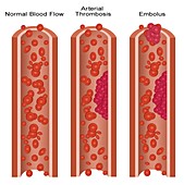 Blood Clots,Illustration