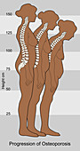 Progression of Osteoporosis,Illustration