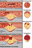 Plaque in Artery,Illustration