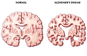 Alzheimer's Disease Brain,Illustration
