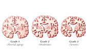 Alzheimer's Progression,Illustration