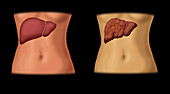 Healthy vs. Cirrhotic Liver,Illustration