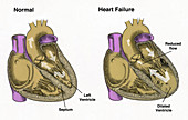Healthy and Failure Hearts,Illustration