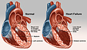Normal and Diseased Hearts,Illustration