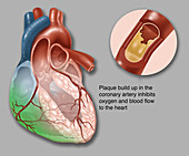 Acute Heart Failure,Illustration