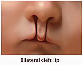 Bilateral Cleft Lip,Illustration