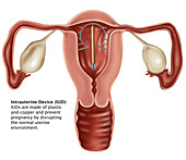 Intrauterine Device,Illustration